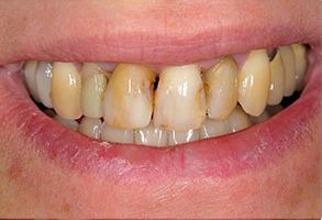 Christopher R. Szydelko, DDS PC | Veneers, Dental Bridges and Dental Sealants